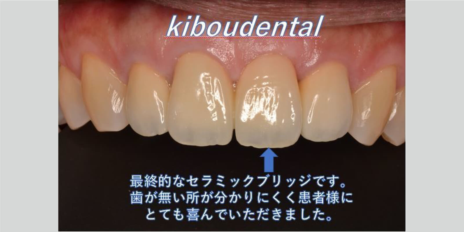 最終的な被せ物が入ったところ