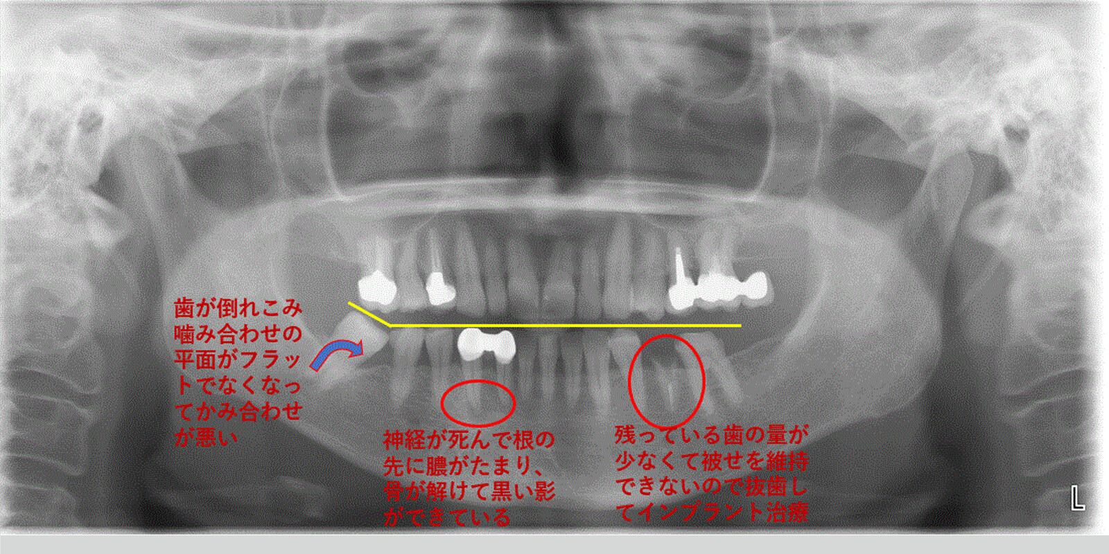 インプラント治療