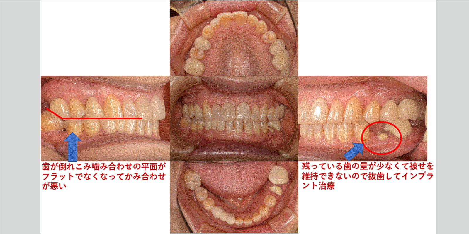 インプラント治療