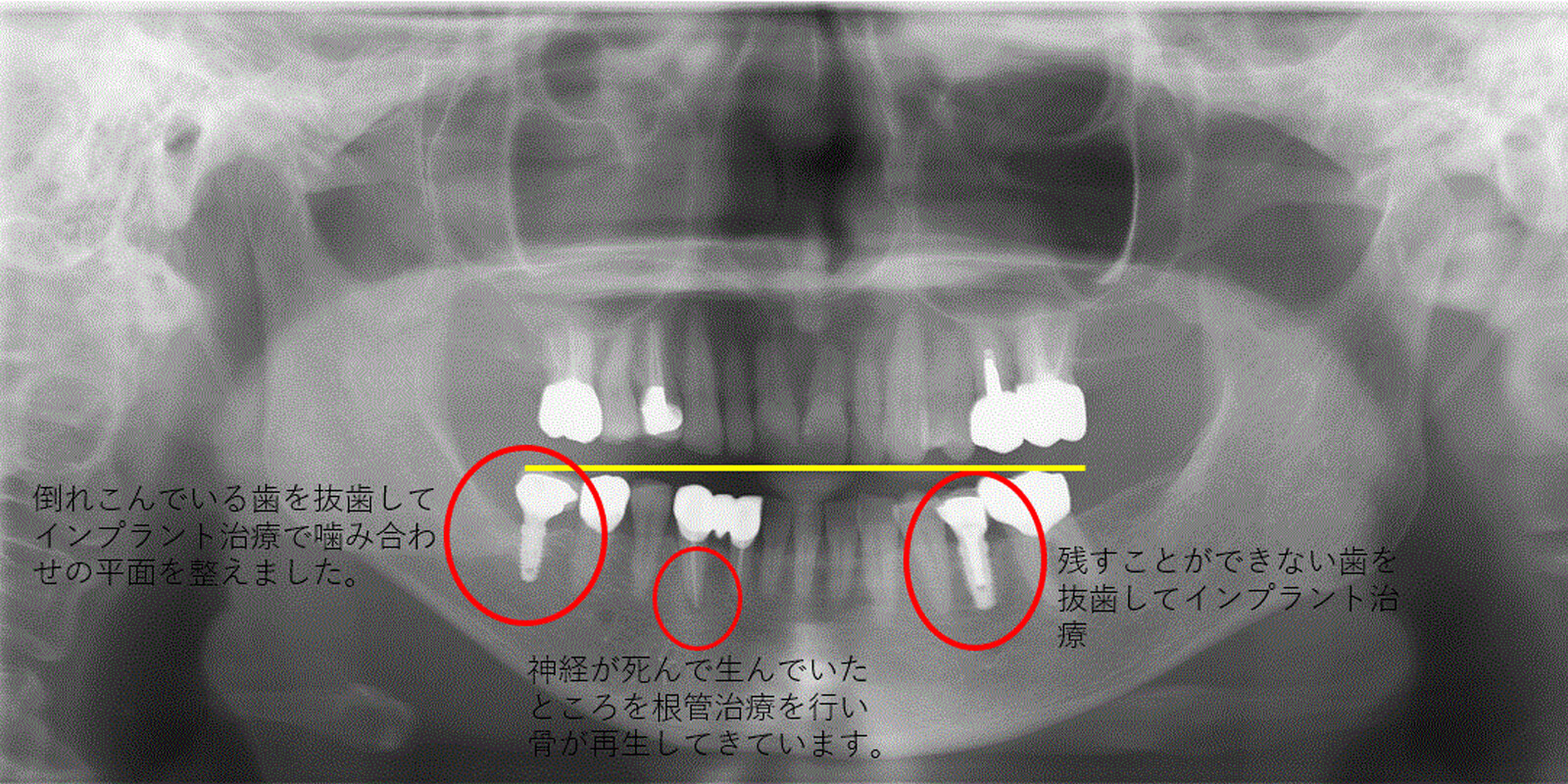 インプラント治療