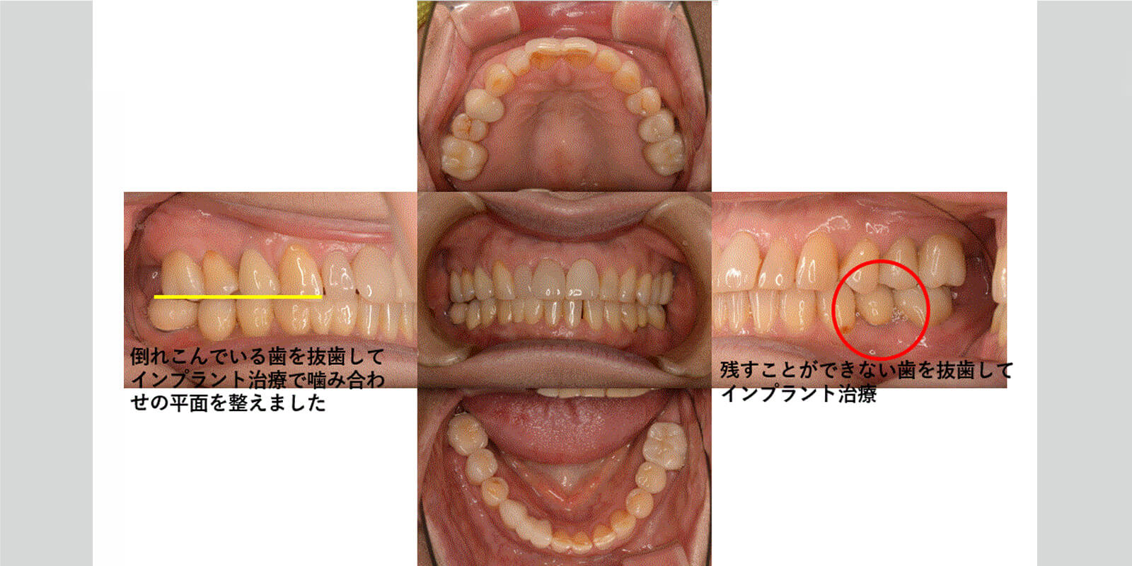 インプラント治療