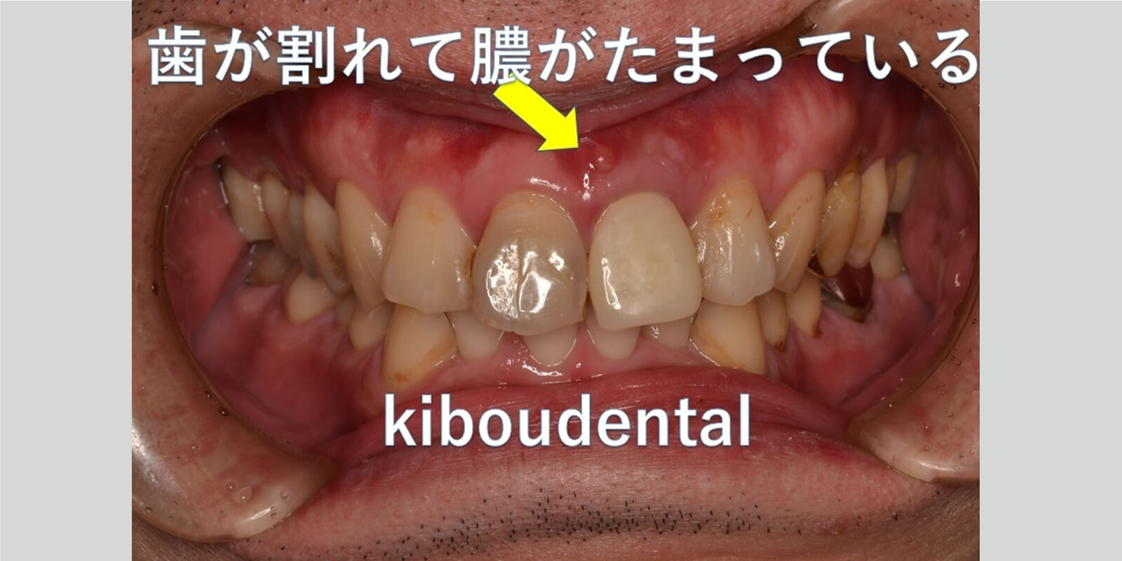 インプラント治療