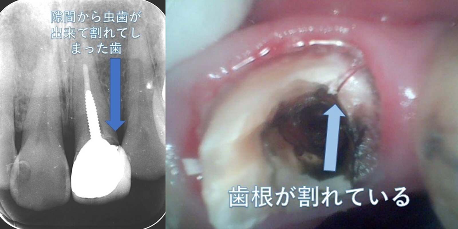 インプラント治療