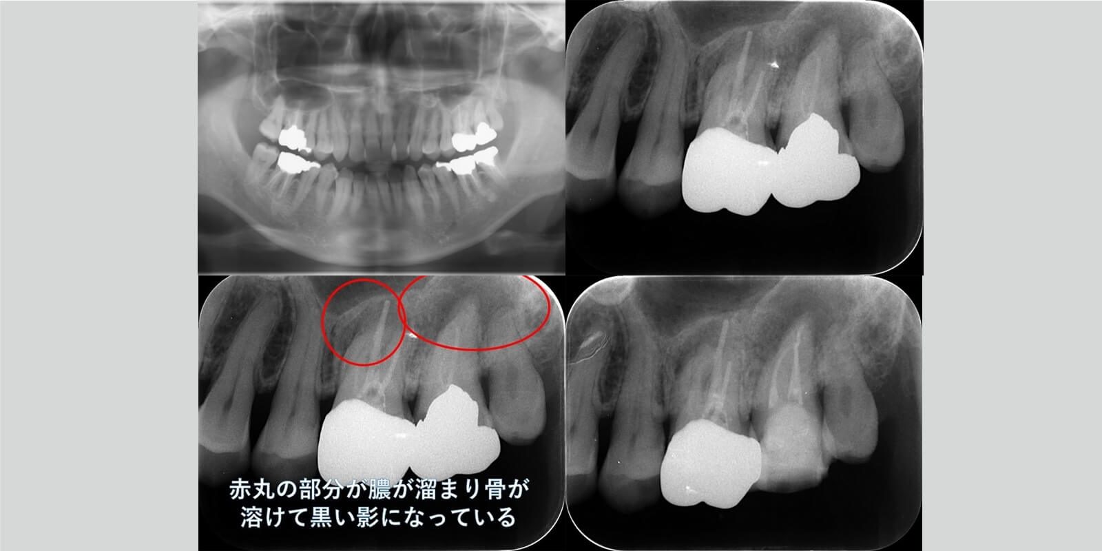 感染根管治療