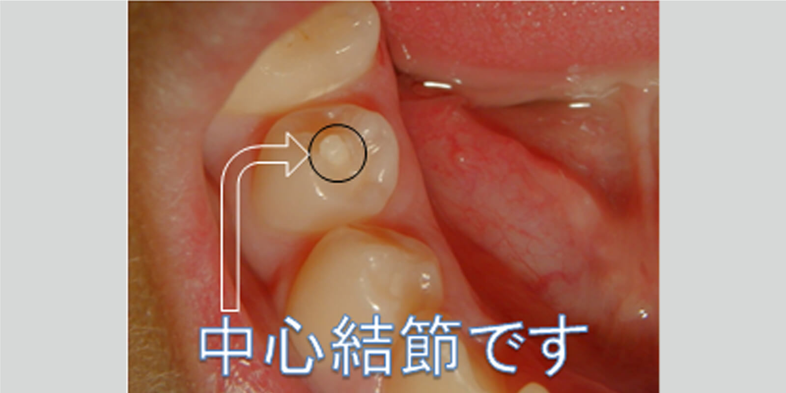 中心結節とは...