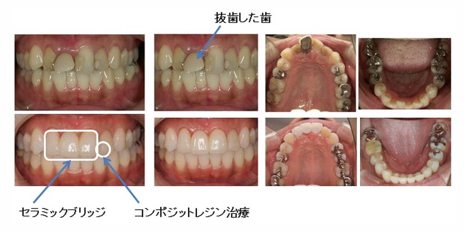 セラミック治療＋レジン治療＋矯正治療