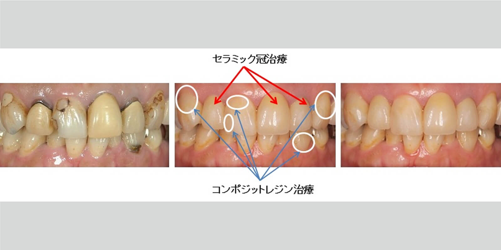 セラミック治療＋レジン治療