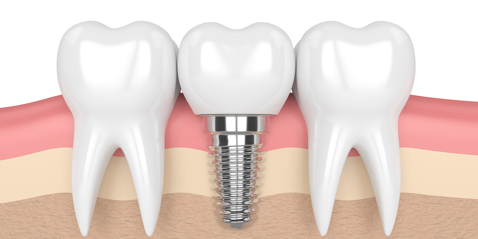 きぼう歯科クリニックのインプラント治療