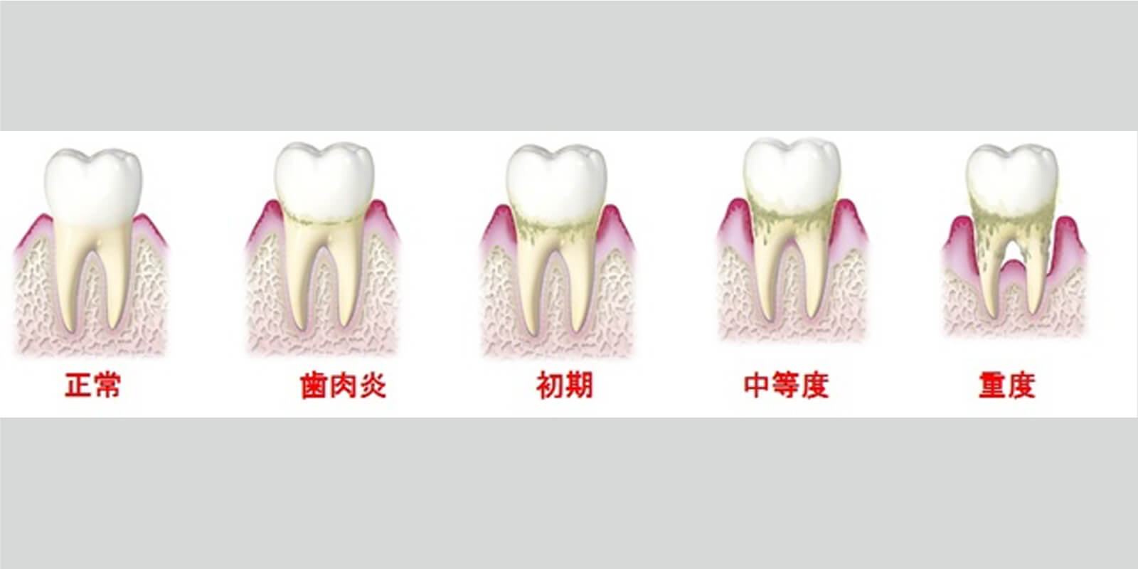 歯周病の進行