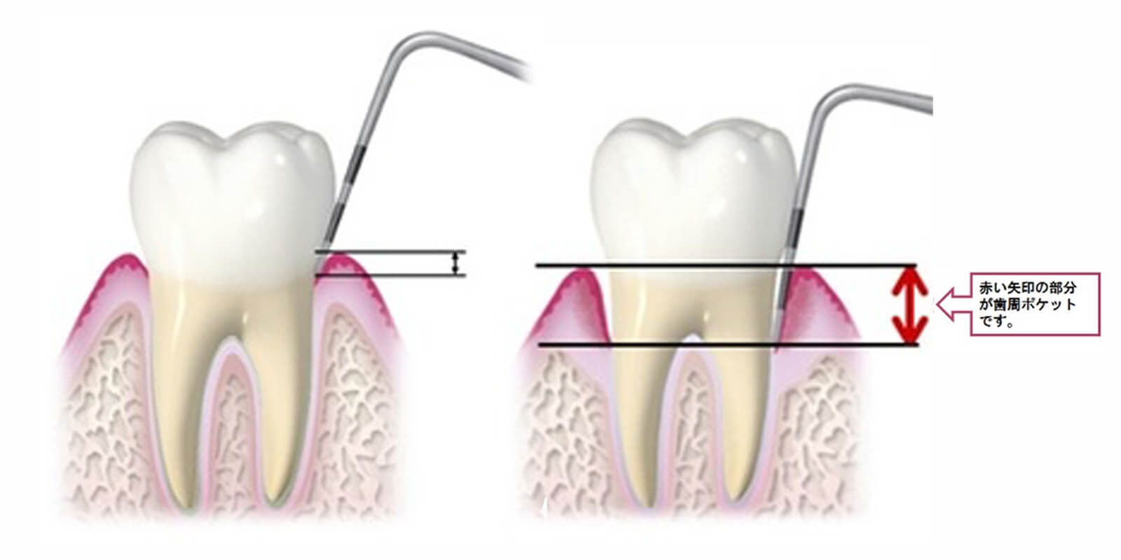 歯周ポケットの検査